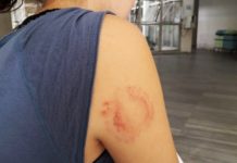 Ladrão morde mulher durante assalto em Natal; GPS localiza celular roubado e PM prende bandidos Vítima levou uma mordida no braço direito durante o assalto — Foto: Klênyo Galvão/Inter TV Cabugi