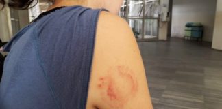 Ladrão morde mulher durante assalto em Natal; GPS localiza celular roubado e PM prende bandidos Vítima levou uma mordida no braço direito durante o assalto — Foto: Klênyo Galvão/Inter TV Cabugi