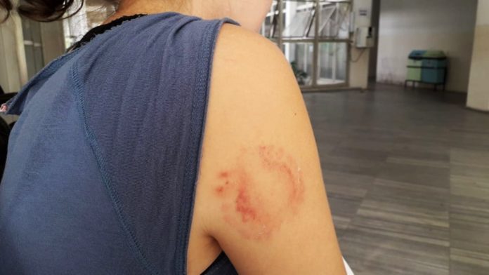 Vítima levou uma mordida no braço direito durante o assalto — Foto: Klênyo Galvão/Inter TV Cabugi