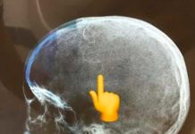 Médicos retiram 40 larvas que estavam comendo cabeça de criança em SP Menina de sete anos foi internada com uma lesão causada por parasitas na cabeça em Praia Grande, SP — Foto: Reprodução/Boca no Trombone PG