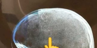 Médicos retiram 40 larvas que estavam comendo cabeça de criança em SP Menina de sete anos foi internada com uma lesão causada por parasitas na cabeça em Praia Grande, SP — Foto: Reprodução/Boca no Trombone PG