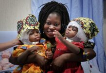 Gêmeas siamesas são separadas pela cabeça na Itália