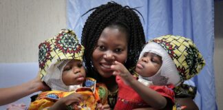 Gêmeas siamesas são separadas pela cabeça na Itália