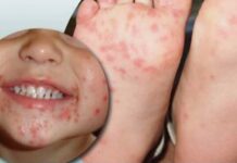 Pediatra alerta para surto da doença ‘mão-pé-boca’ em crianças no RN