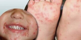 Pediatra alerta para surto da doença ‘mão-pé-boca’ em crianças no RN