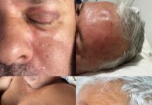 Hematomas Chocantes Revelam Agressões ao Prefeito Julio Cesar