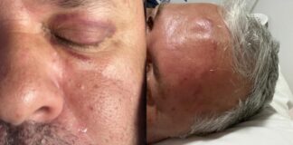 Hematomas Chocantes Revelam Agressões ao Prefeito Julio Cesar